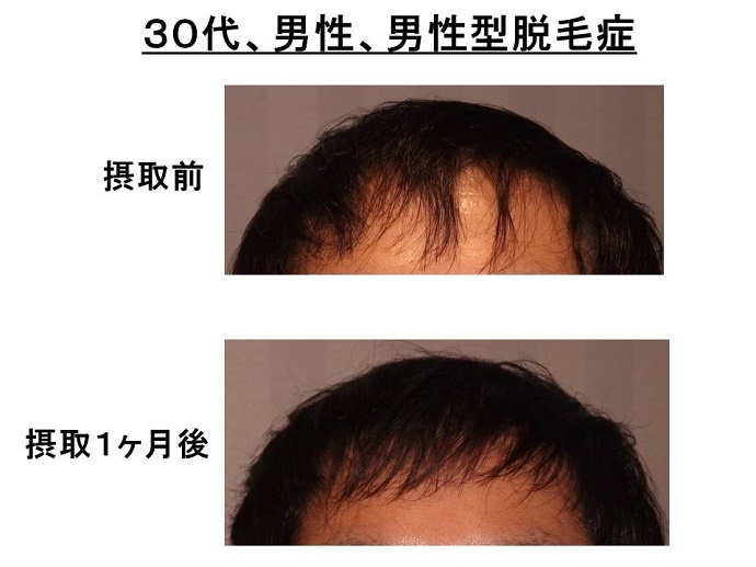 円形脱毛症　病院""